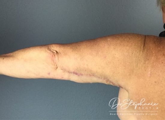 After arm lift Dallas TX