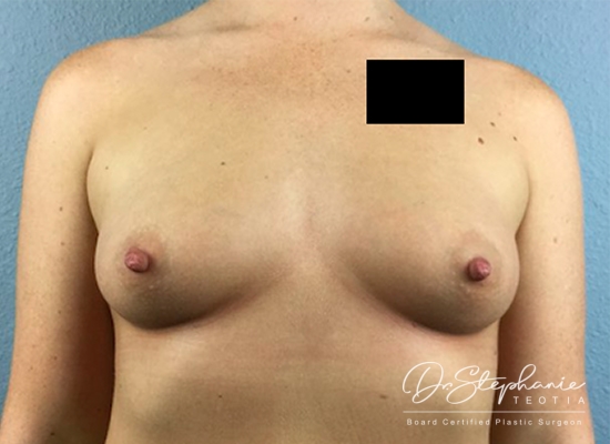 Before breast augmentation front view case 1877