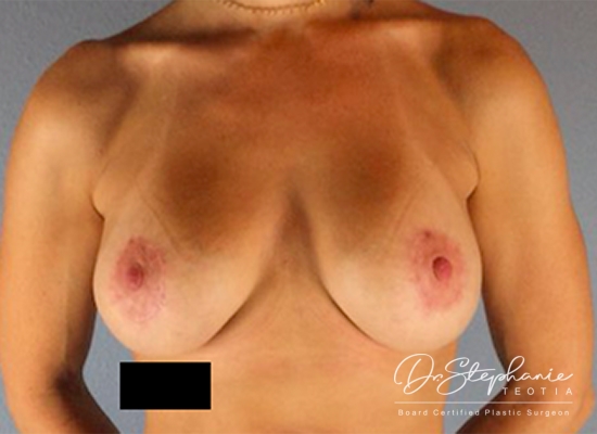 After breast implant removal/replacement front view case 1862