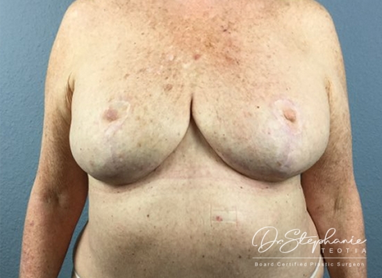 After breast reduction front view case 1831