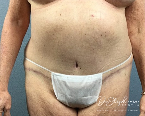 After tummy tuck front view case 1718