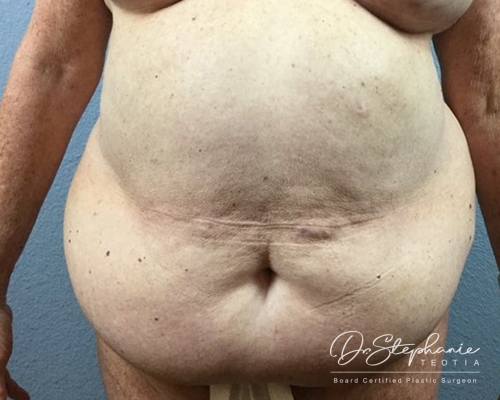 Before tummy tuck front view case 1718