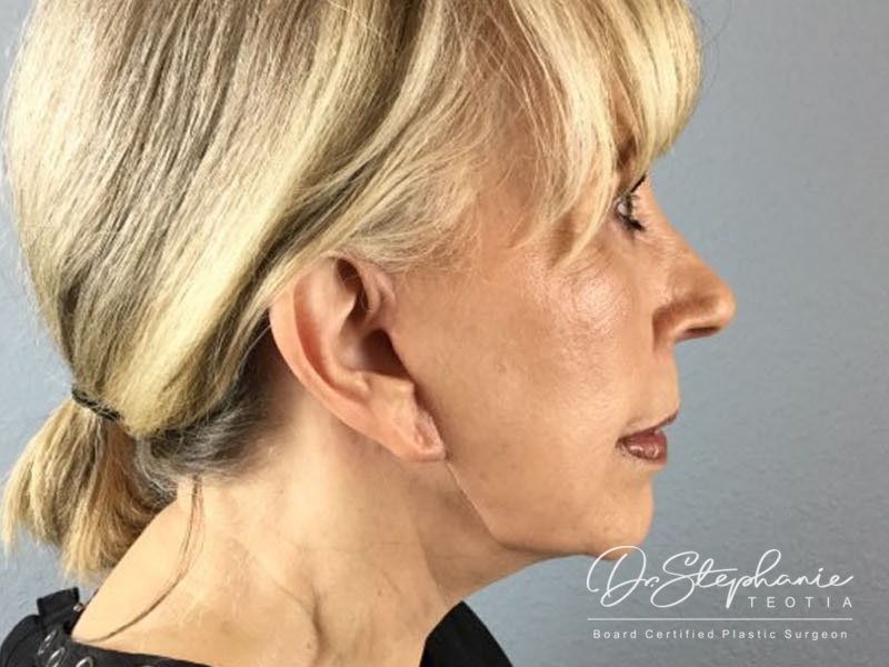 after facelift right side female patient case 3379