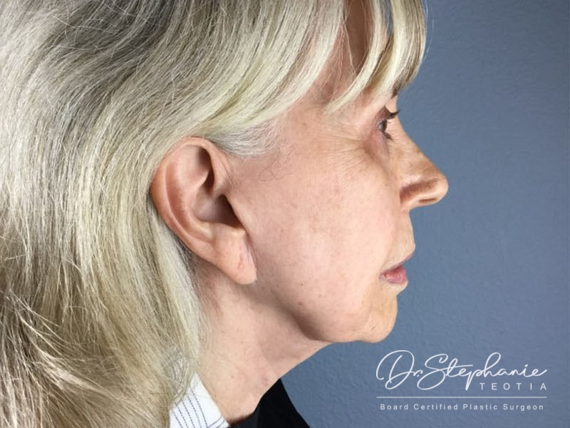 before neck lift right side female patient case 3380