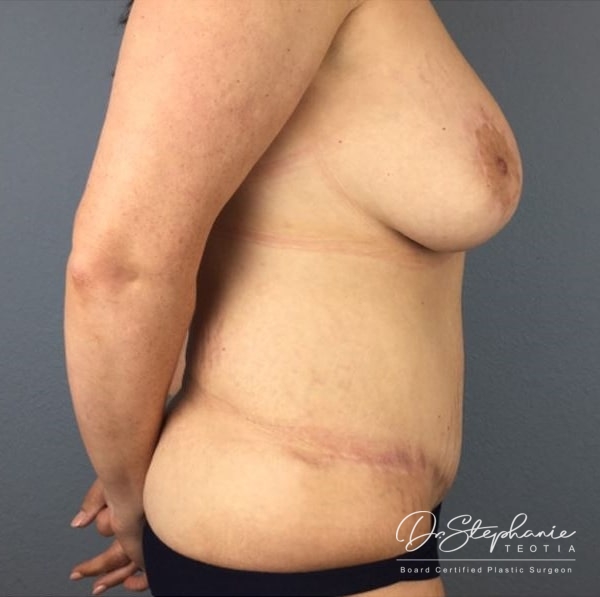 after breast lift side view female patient case 3521