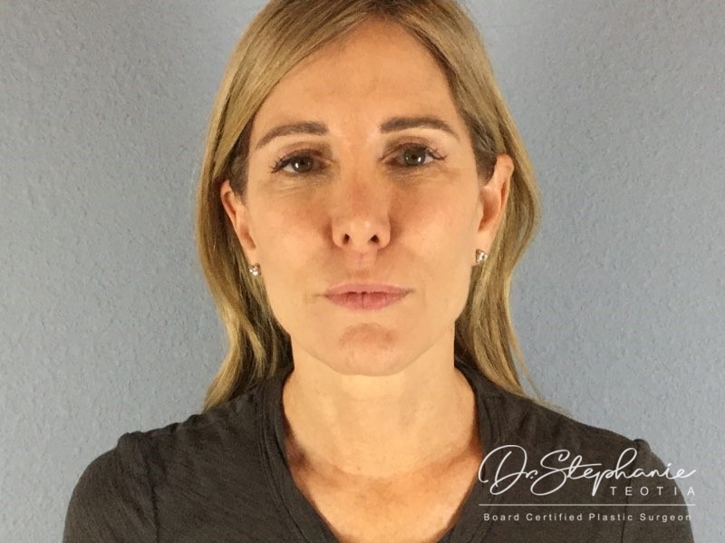 before neck lift front view female patient case 3502