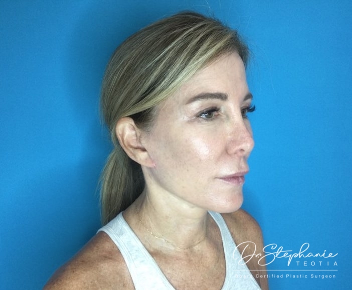 after neck lift right angle view female patient case 3502