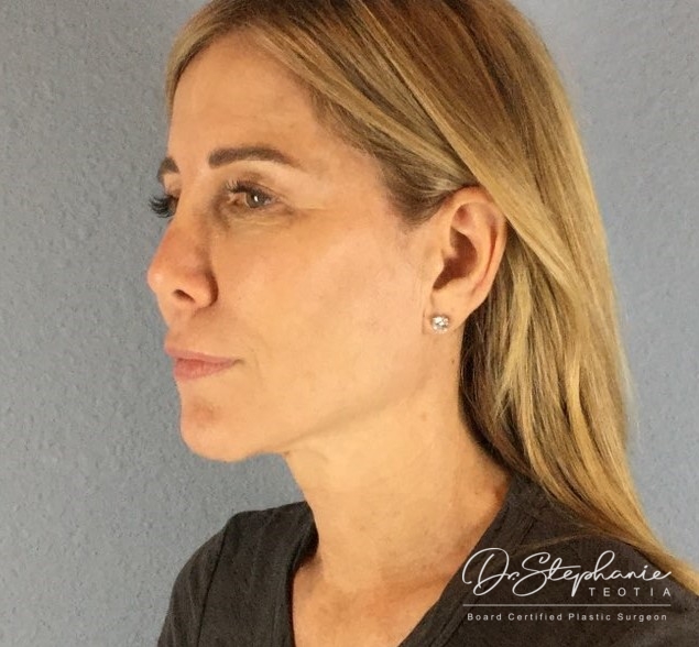 before neck lift left angle view female patient case 3502