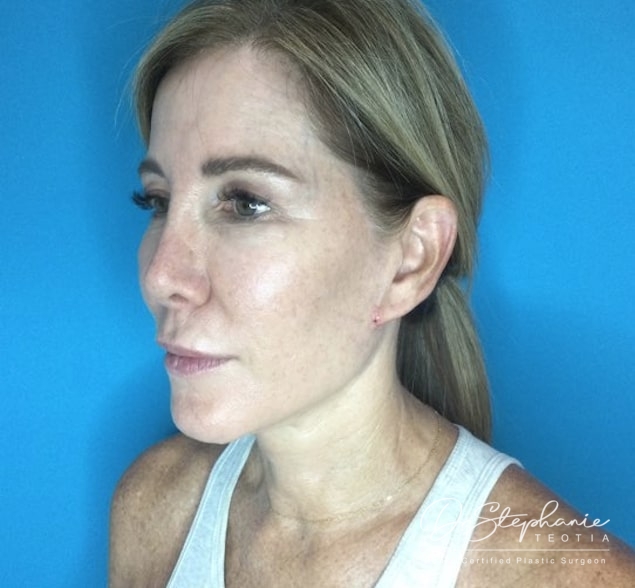 after neck lift left angle view female patient case 3502