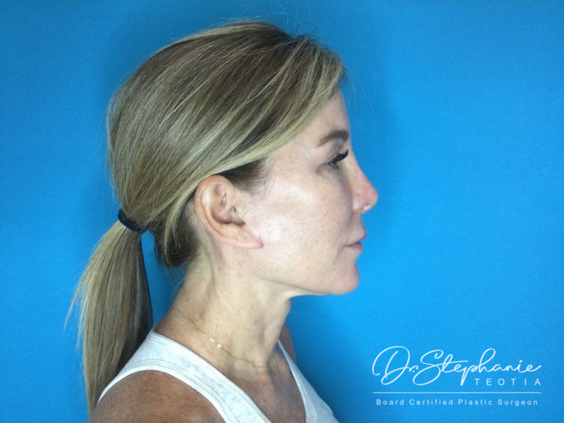 after neck lift right side view female patient case 3502