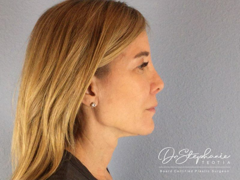 before neck lift right side view female patient case 3502