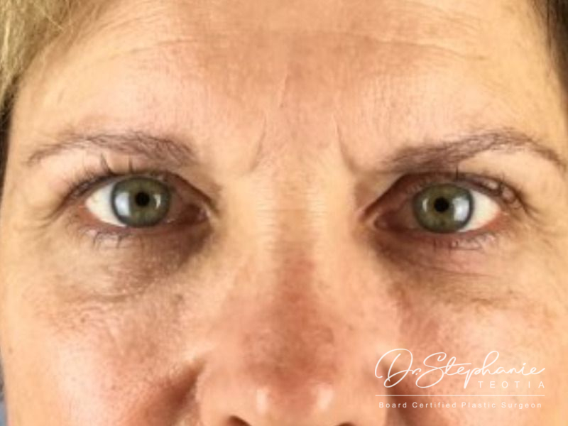 before blepharoplasty front view female patient case 3803