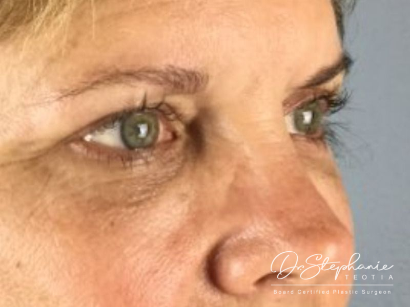 before blepharoplasty angle view female patient case 3803