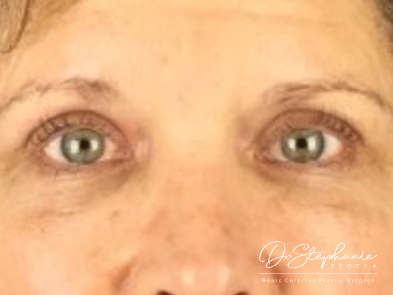 after blepharoplasty front view female patient case 3888