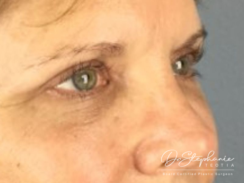 after blepharoplasty angle view female patient case 3803