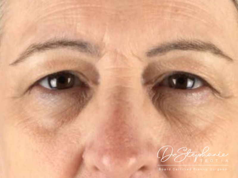 before blepharoplasty front view female patient case 3888