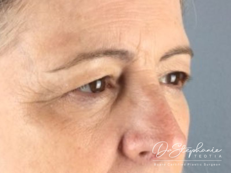 before blepharoplasty angle view female patient case 3888