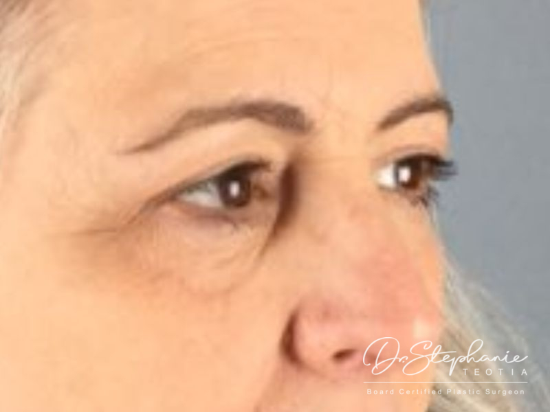 after blepharoplasty angle view female patient case 3888