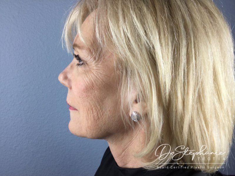 before facelift side view female patient case 3868