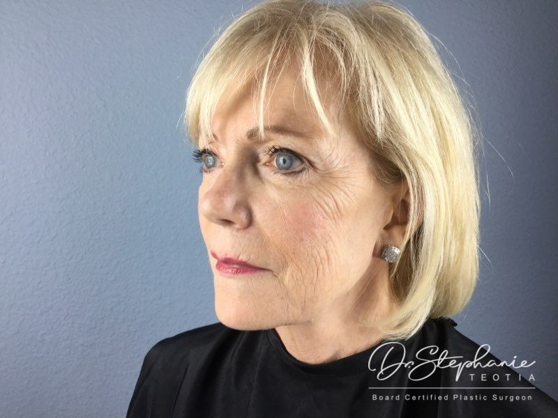 before facelift angle view female patient case 3868