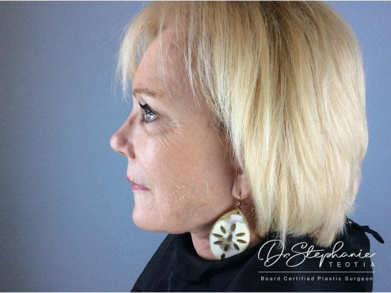 after facelift side view female patient case 3868