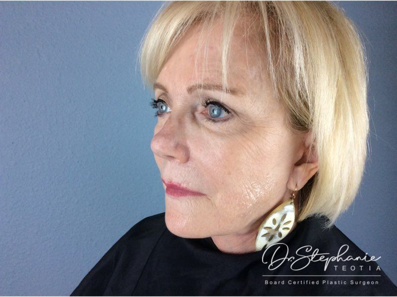 after facelift angle view female patient case 3868