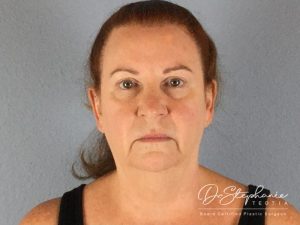 before facelift front view female patient case 3873