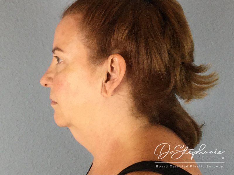 before facelift side view female patient case 3873