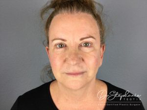 after facelift front view female patient case 3873