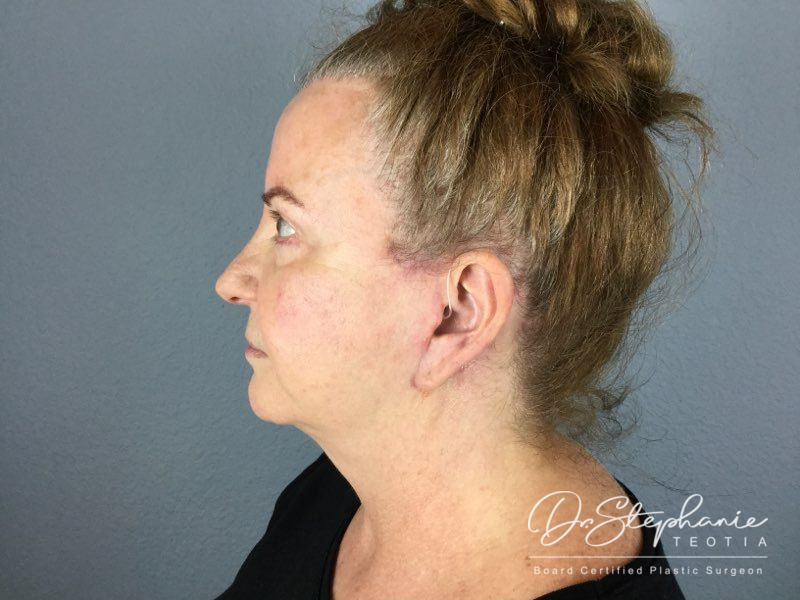 after facelift side view female patient case 3873