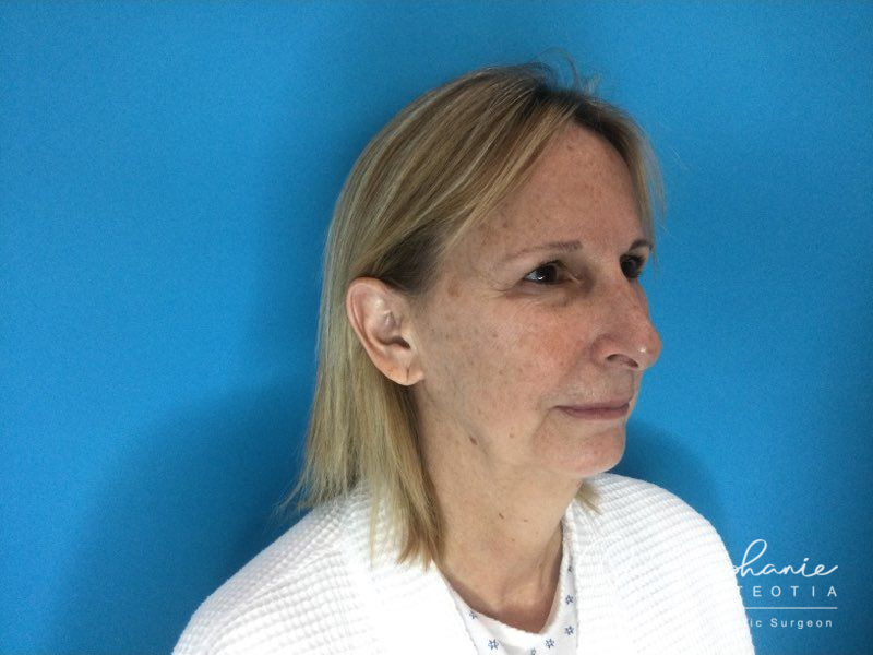 before facelift angle view female patient case 3909