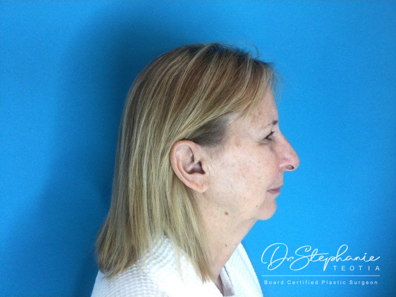 before facelift side view female patient case 3909
