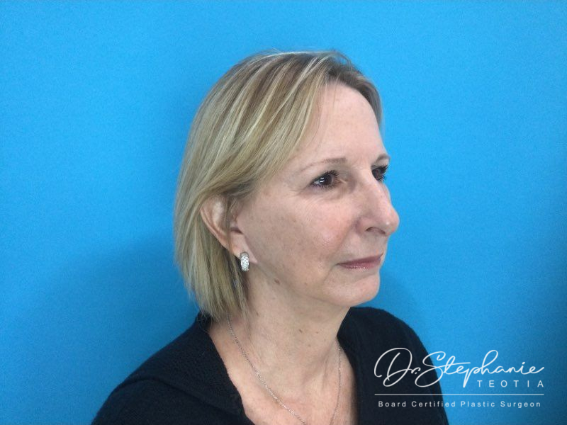 after facelift angle view female patient case 3909
