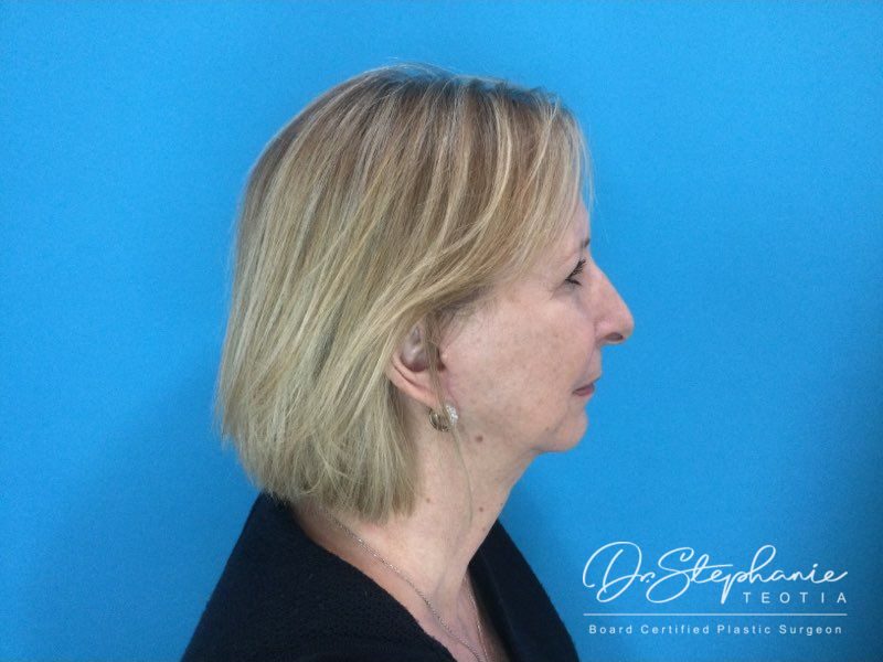 after facelift side view female patient case 3909