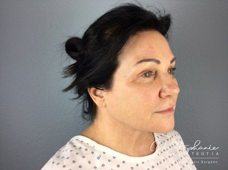 before neck lift angle view female patient case 3894