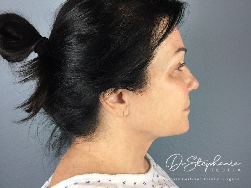 before neck lift side view female patient case 3894