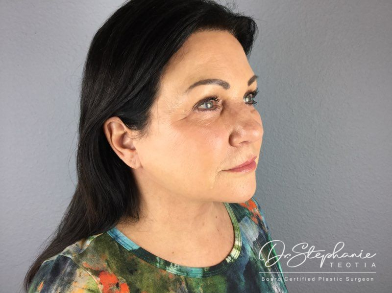 after neck lift angle view female patient case 3894