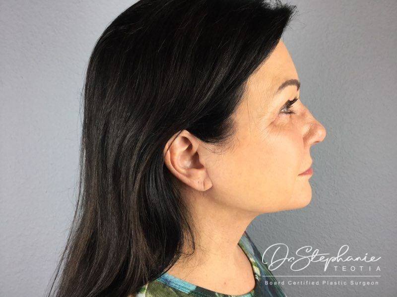 after neck lift side view female patient case 3894