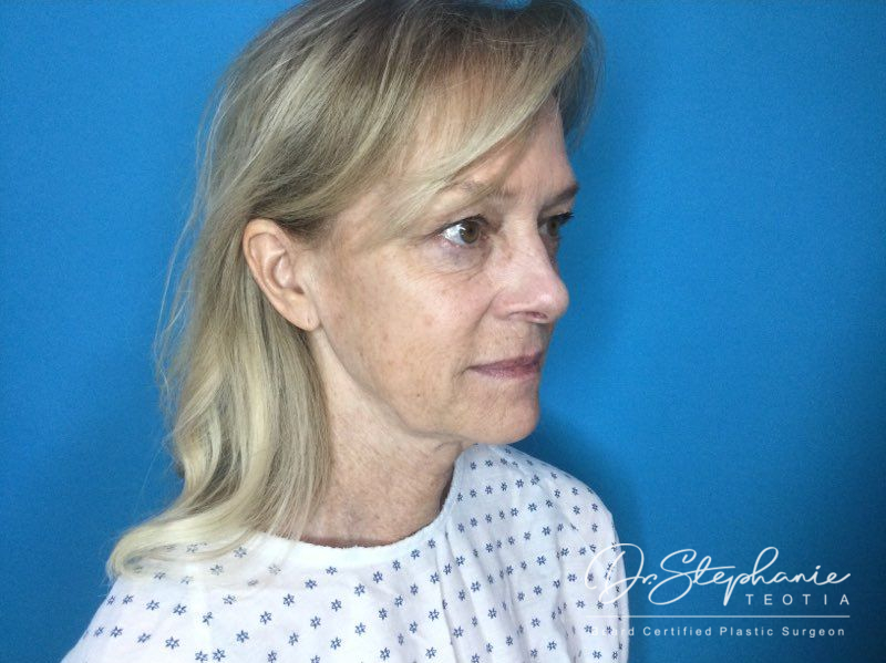 before neck lift angle view female patient case 3899