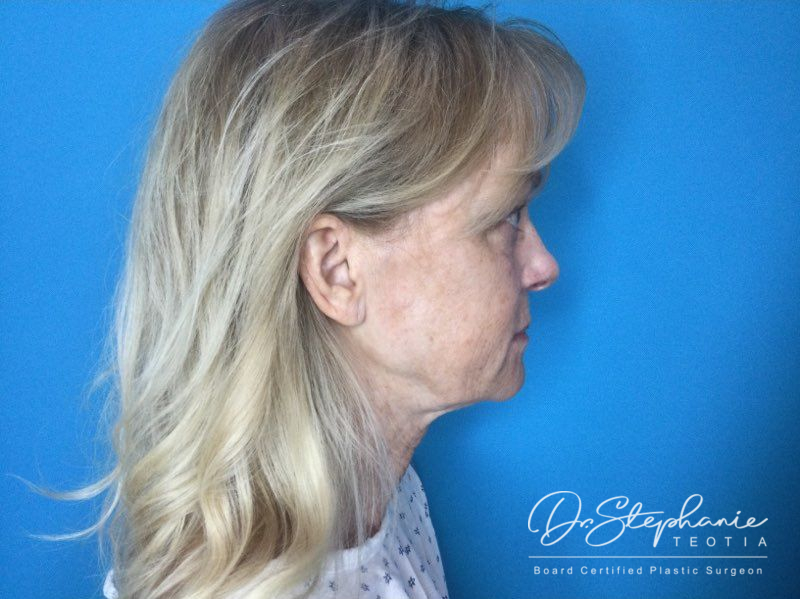 before neck lift side view female patient case 3899