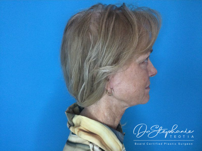 after neck lift side view female patient case 3899