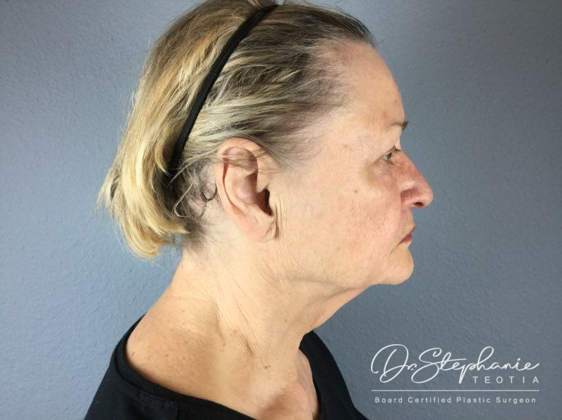 before facelift side view female patient case 3904