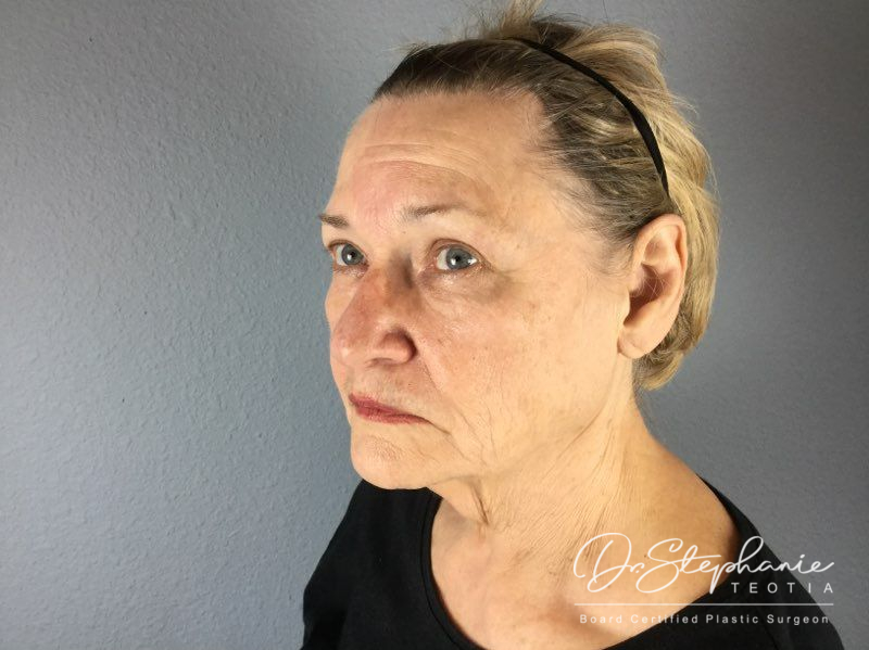 before facelift angle view female patient case 3904