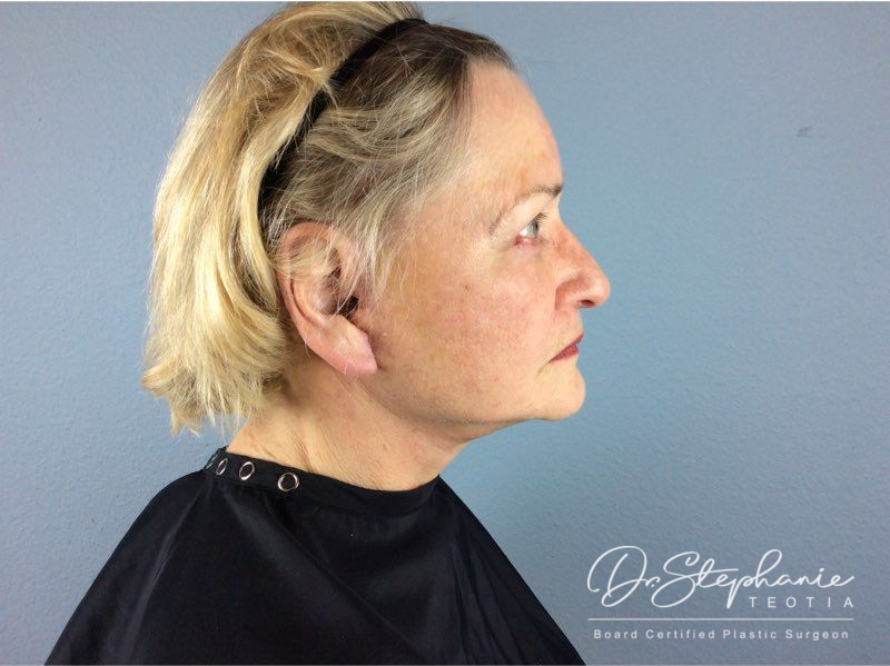 after facelift side view female patient case 3904
