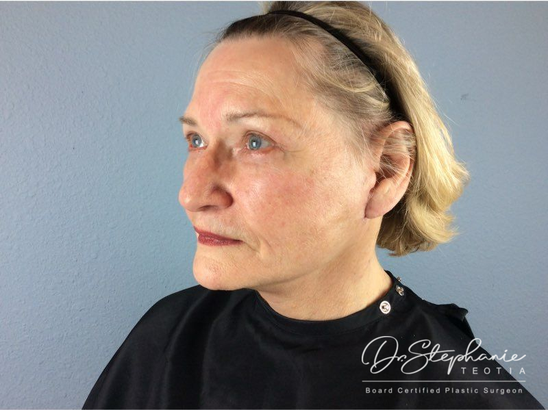 after facelift angle view female patient case 3904