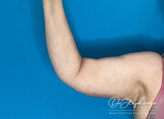 after arm lift front view female patient case 3971