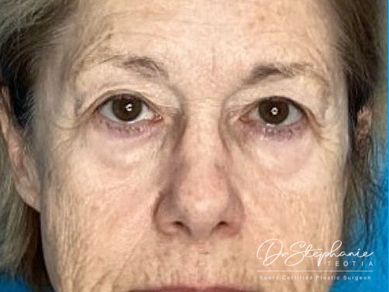 before blepharoplasty front view female patient case 3962