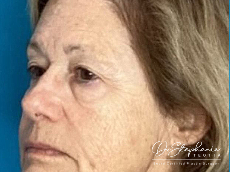 before blepharoplasty angle view female patient case 3962
