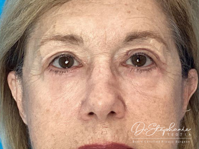 after blepharoplasty front view female patient case 3962