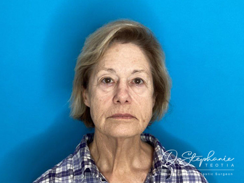 before facelift front view female patient case 3957